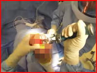 膝の関節を人工関節に付け替える手術の映像。骨を砕くドリルが怖すぎる(@_@;)