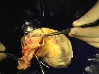 医療動画。心臓移植の手術を撮影したビデオ。お医者さんってマジ凄いなあ。