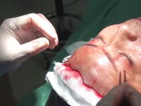 高須クリニックのフェイスリフト手術の映像が激コワ。おまけで豊胸手術あり。