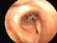 これはイヤァァァ！耳の穴に虫が入り込むとか想像するだけで恐ろしい。な動画。