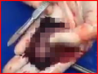 中絶？流産？して取り出された数センチサイズの胎児が医師の手のひらの上で動いている動画