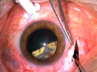 眼球に刺さった大きなガラス片を取り除く手術の映像。思ったよりデカかった(°_°)