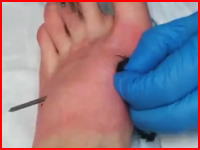 ぎゃー痛い(@_@;)足を貫通してしまった釘を一気に引っこ抜くビデオ(@_@;)