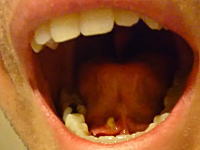 舌の裏から驚きの大きさの唾石がでてきた動画。こんなのあるんだな(((ﾟДﾟ)))