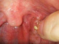 喉の奥に出来る「臭い玉」を指を使って除去する方法。ポロポロ取れる(°_°)