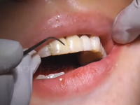 虫歯でボロボロになった20代女性の歯を治療する歯医者さん動画。わずか一日でここまできれいに。
