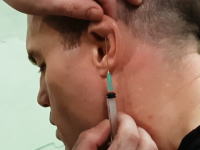柔道耳は注射器ですぐに処置をすると防げるらしい動画。【80へぇ】