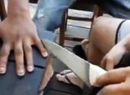 小指にできた大きなイボをナイフと金槌でガツンッ！と取り除くブラジル。