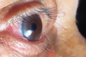 インドの60歳男性の眼球からビックリする長さの寄生虫が摘出される動画。