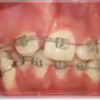 絶望的な歯並びが歯列矯正により修正されていくまでの過程の映像が凄い