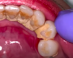 定期的に見たくなる？歯医者さんの歯石取り動画。最大級の歯石取りは少しヤバめ。