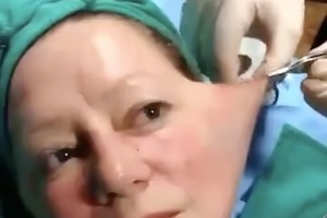 【動画】顔のたるみを取るフェイスリフトの手術。ゴム風船をいじっているみたいだった。