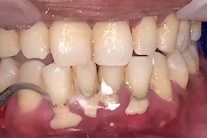 【スッキリ】何年も放置された歯石をがっつり除去する歯医者さんの動画。