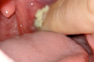 喉の奥の臭い玉（膿栓）が大量に取れてしまう動画がキモいスッキリ。