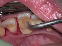 すっきり動画。歯医者さんによる歯石除去の解説。歯石がぱかっと取れる。