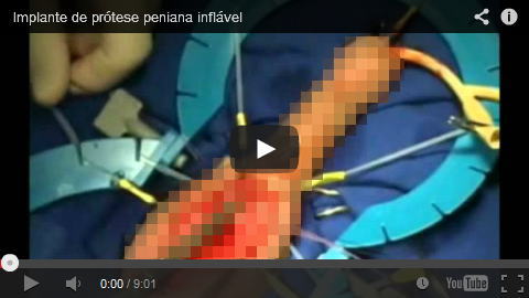 Implante de prótese peniana inflável