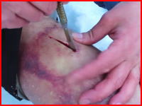滑落して怪我した登山家が生き残る為にその場で自分で手術する。再生注意動画。