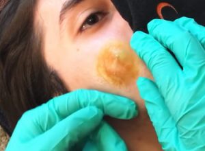 彼氏のほっぺたに出来た大きなデキモノを摘出してみた動画がぐええええ(@_@;)