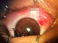 眼球に刺さったえんぴつを取り除く手術のビデオ。思ったよりぐっさり刺さってた(((ﾟДﾟ)))