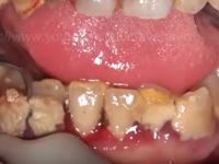 汚いけど見たくなる。長年放置された歯石を取り除く歯医者さん動画。