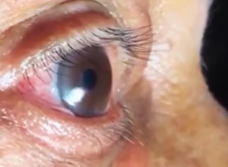 インドの60歳男性の眼球からビックリする長さの寄生虫が摘出される動画。