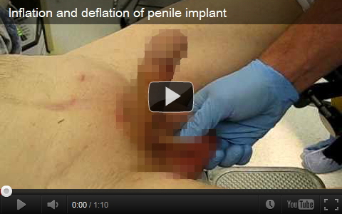 ポンプで勃起を助ける陰茎インプラントを埋め込んだ男性のペニス。医療動画