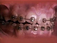 歯の矯正器具で歯列が整っていく様子を60秒に縮めて見てみましょう