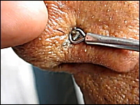 鼻の毛穴に詰まった角栓を特殊な道具で取り除く映像。ニュルニュルと・・・。